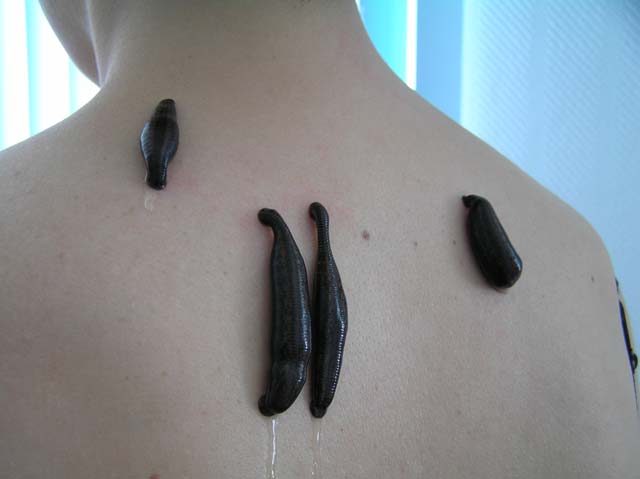 Гирудотерапия